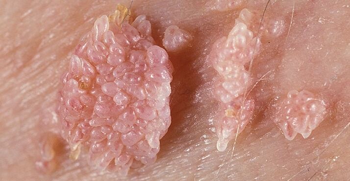Condyloma erraldoia