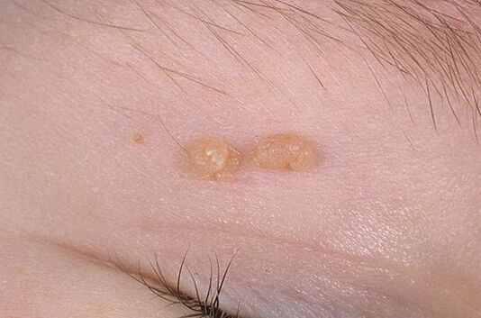 Papiloma arrunta
