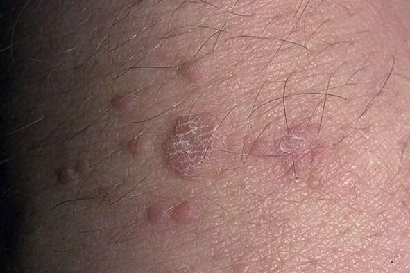 Papiloma laua