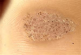Larruazalean