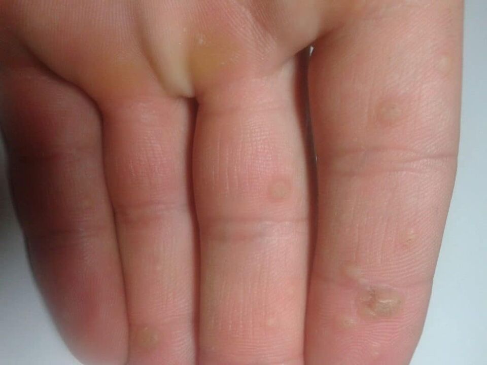Warts vulgarrak