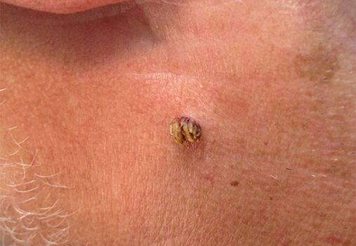 Papiloma lepoan