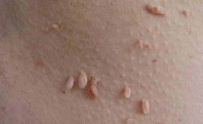 giza gorputzean papilomak agertzearen arrazoiak