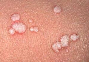 Papiloma arruntak giza gorputzean