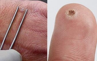 Papilomaren sintomak giza gorputzean