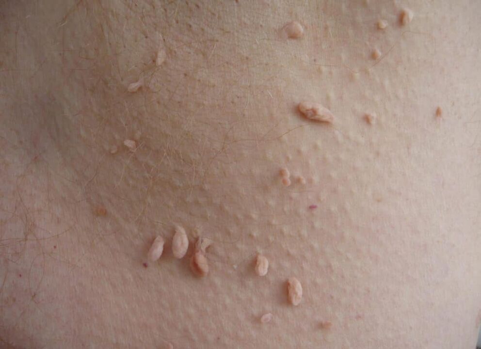 lepoan papiloma motak