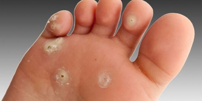 nolakoak dira oinetako garatxo plantarrak